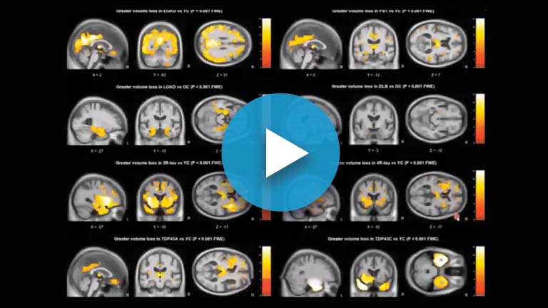 MRI interpretation in dementia webinar landing page